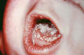 Red skin syndrome oral steroids