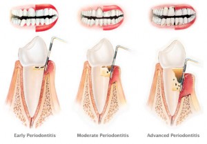 early periodontitis